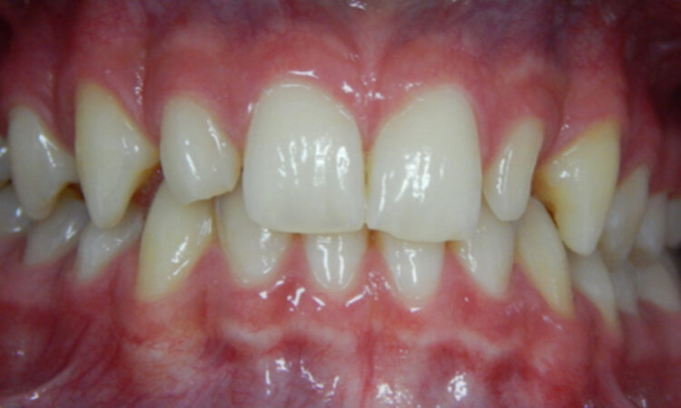 Before - puredental