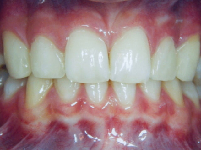 After - puredental