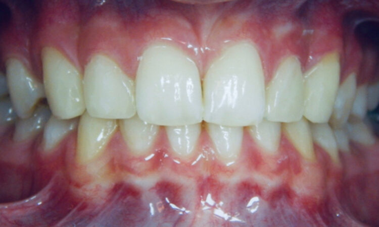 After - puredental