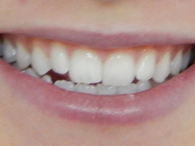 Before - puredental