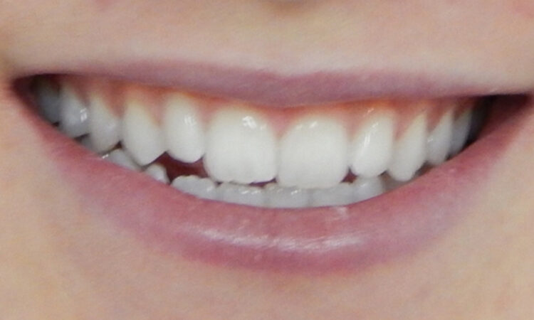 Before - puredental
