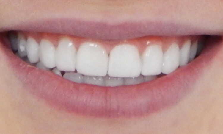 After - puredental