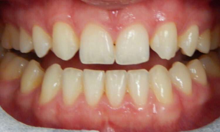 Before - puredental
