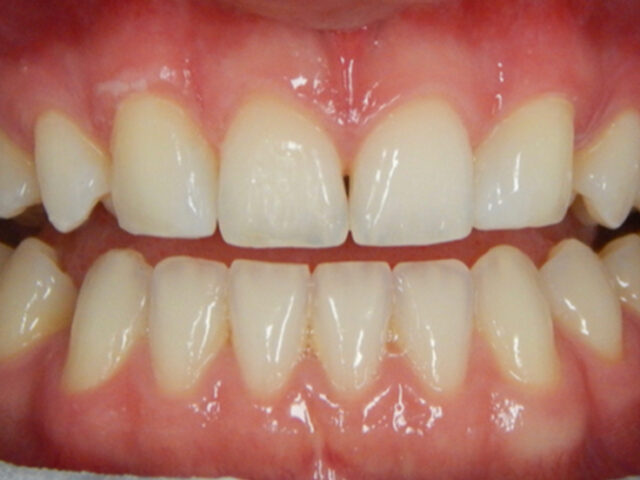 After - puredental