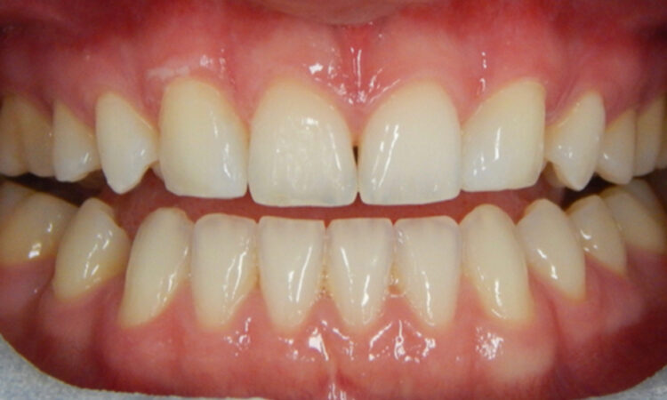 After - puredental