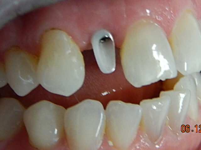Before - puredental