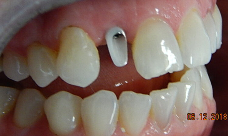 Before - puredental