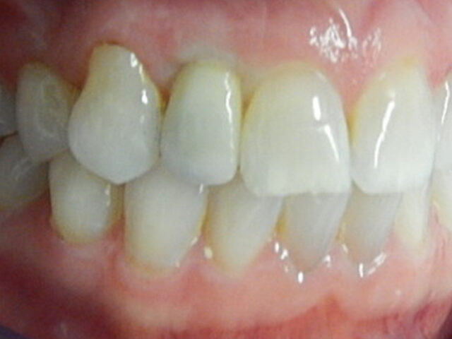 After - puredental