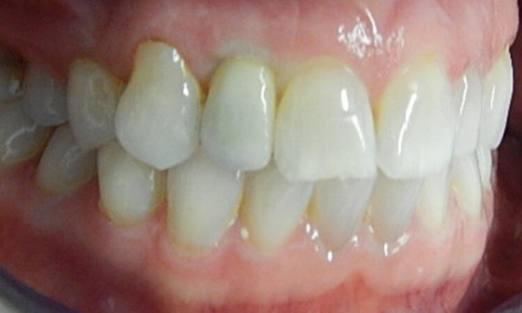 After - puredental