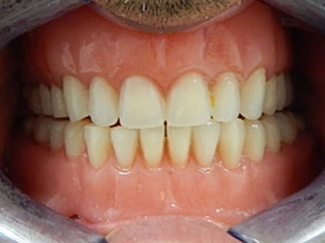 After - puredental