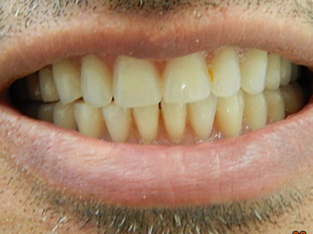 After - puredental