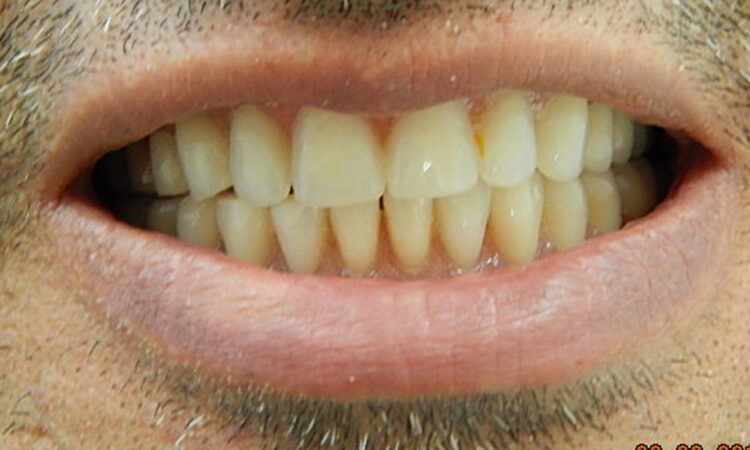 After - puredental