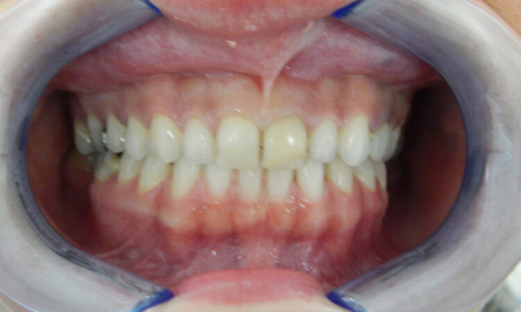 Before - puredental