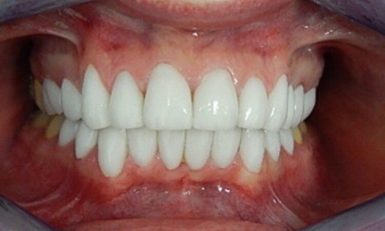 After - puredental