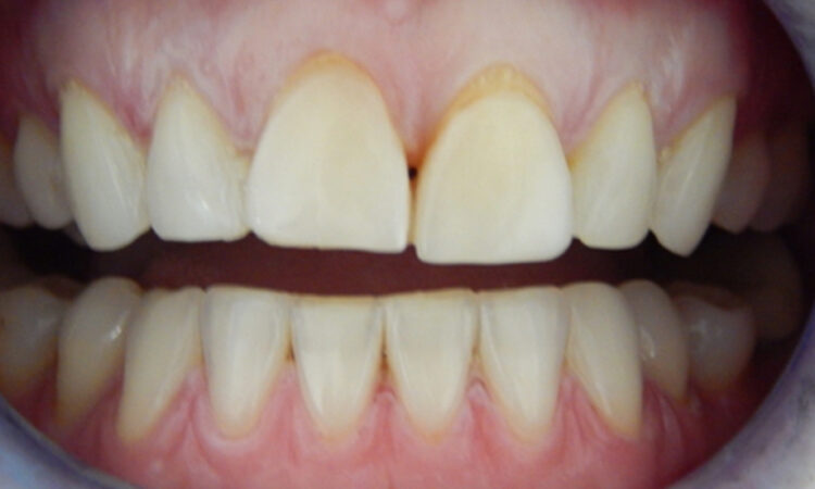 Before - puredental