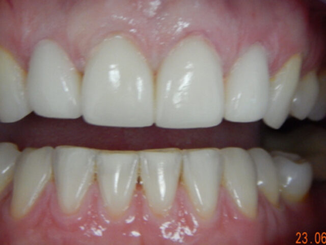 After - puredental