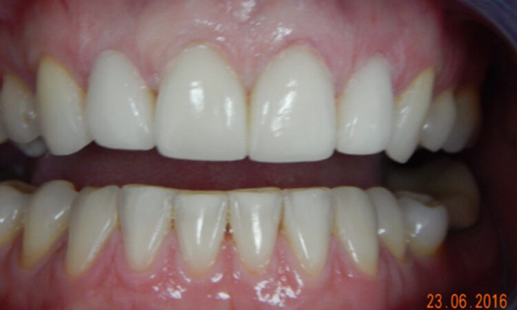 After - puredental