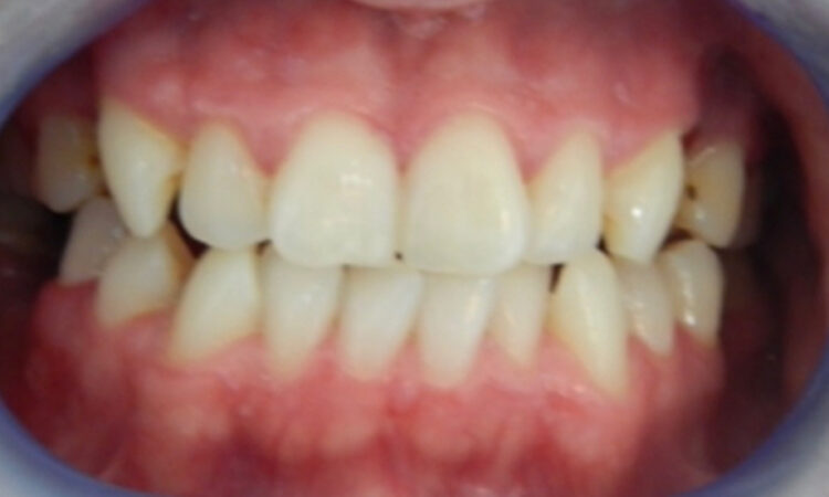 Before - puredental