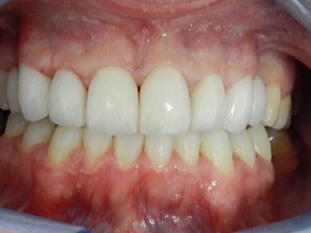 After - puredental