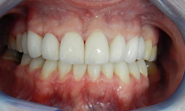 After - puredental