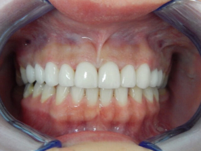 After - puredental