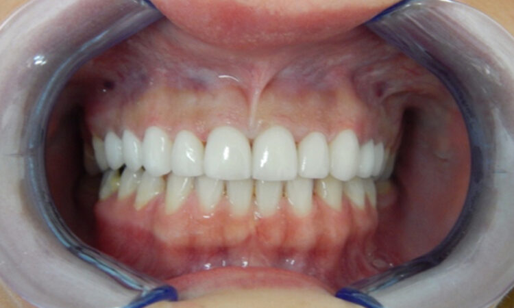 After - puredental