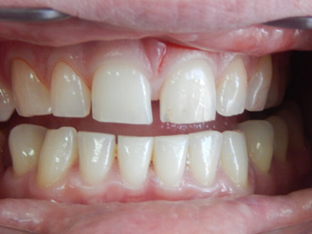 Before - puredental