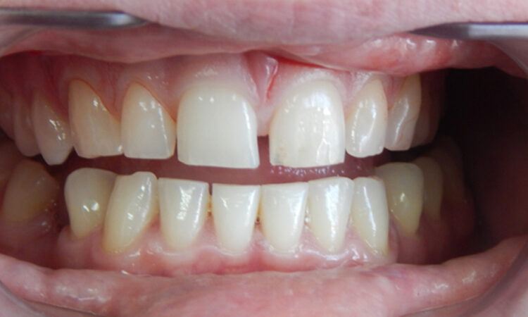 Before - puredental
