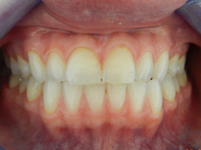 Before - puredental
