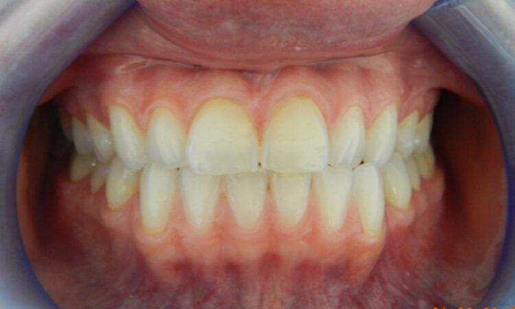 Before - puredental