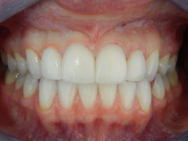 After - puredental