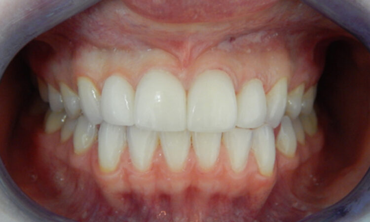 After - puredental