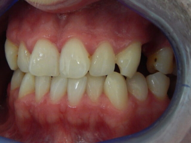 Before - puredental