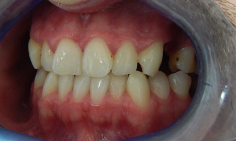 Before - puredental