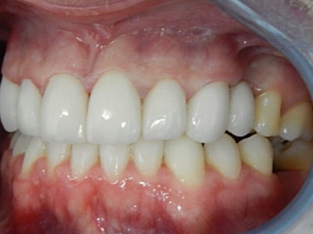 After - puredental