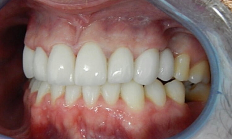 After - puredental