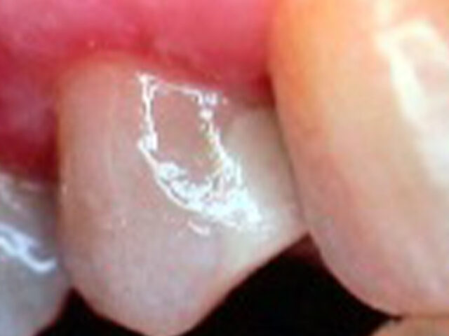 After - puredental