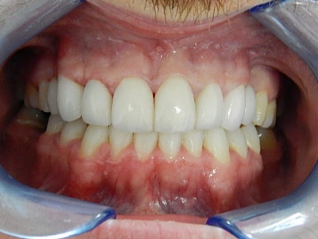 After - puredental