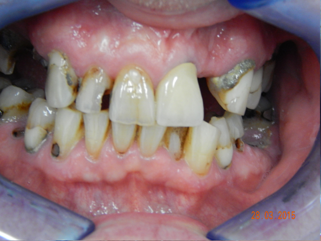 Before - puredental