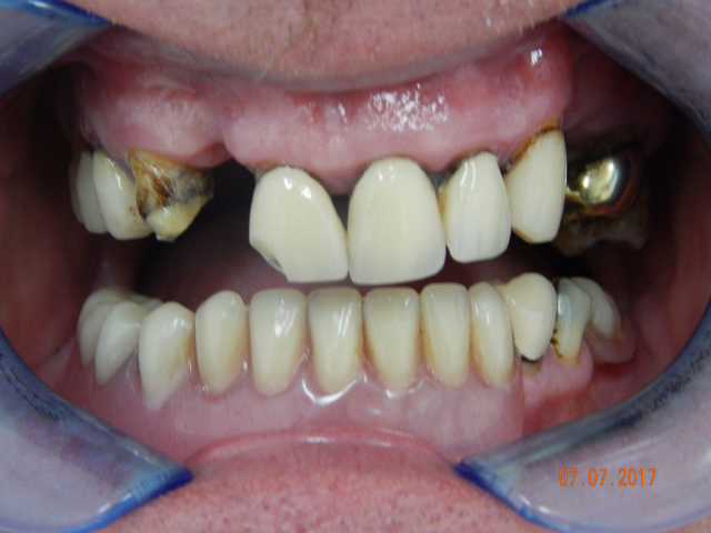 Before - puredental