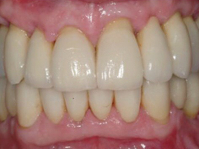 After - puredental