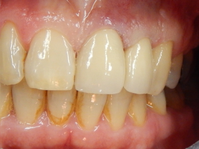 After - puredental
