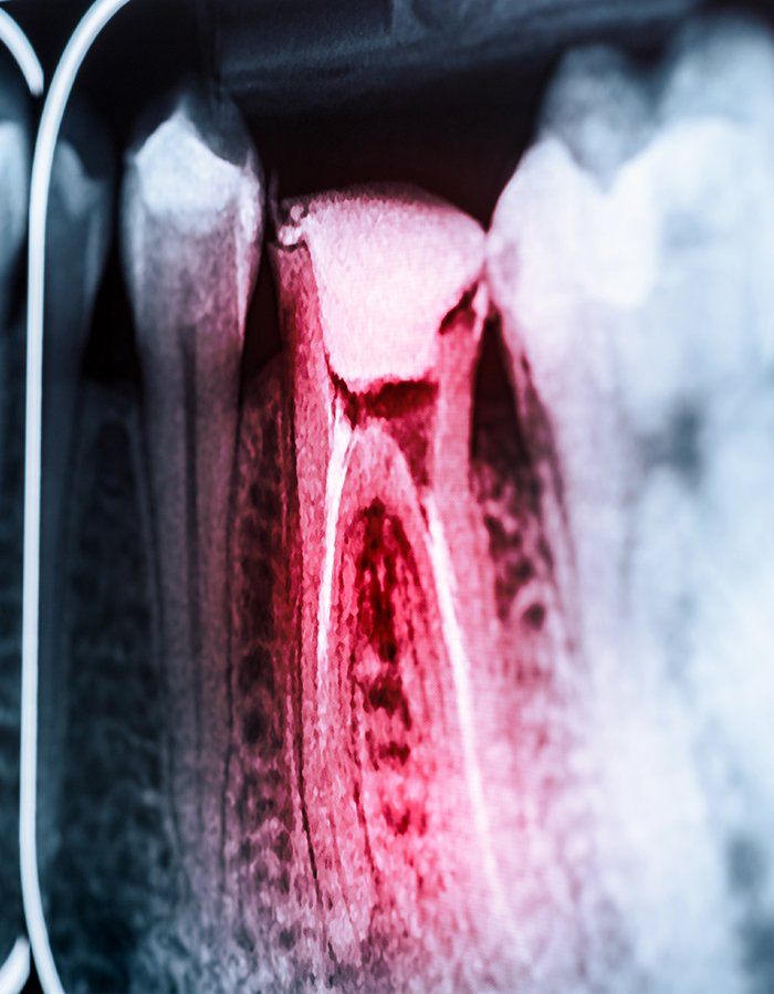 Treatment - Pure Dental