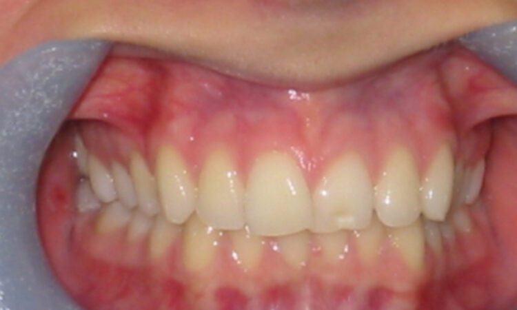 Before - puredental
