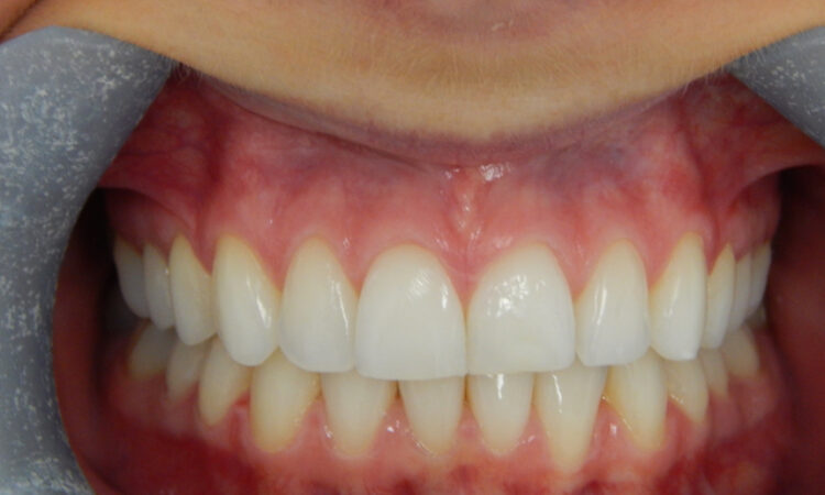 After - puredental