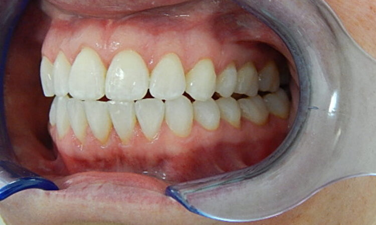 After - puredental