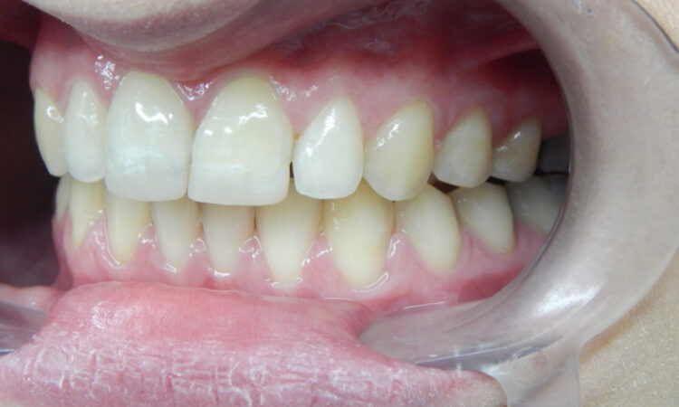 After - puredental