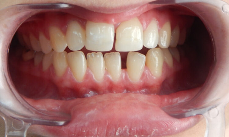 Before - puredental