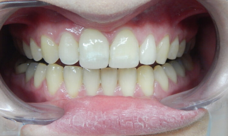 After - puredental