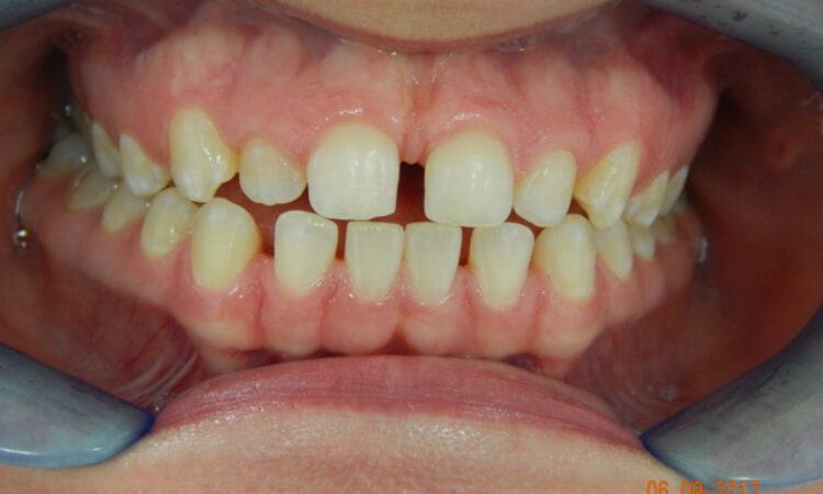 Before - puredental